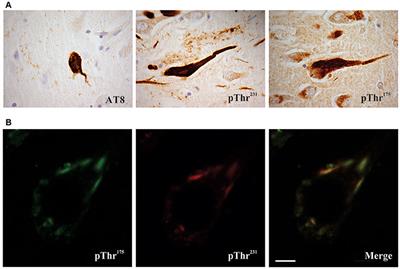 Phosphorylation of Threonine 175 Tau in the Induction of Tau Pathology in Amyotrophic Lateral Sclerosis—Frontotemporal Spectrum Disorder (ALS-FTSD). A Review